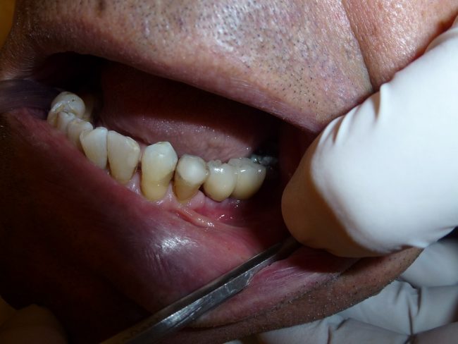 Teeth Whitening