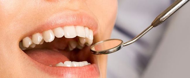 teeth whitening